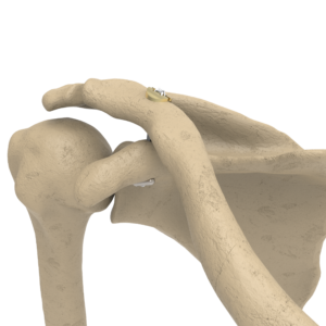 DIB-AC con colocador FLIP-H (Botón ajustable de reducción Acromio Clavicular o Tobillo)