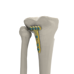PLACA TIBIAL EN T