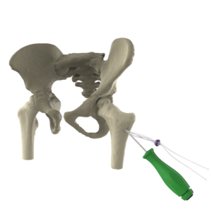 FLIP-H LOCK - Endobotton para cadera pediátrica